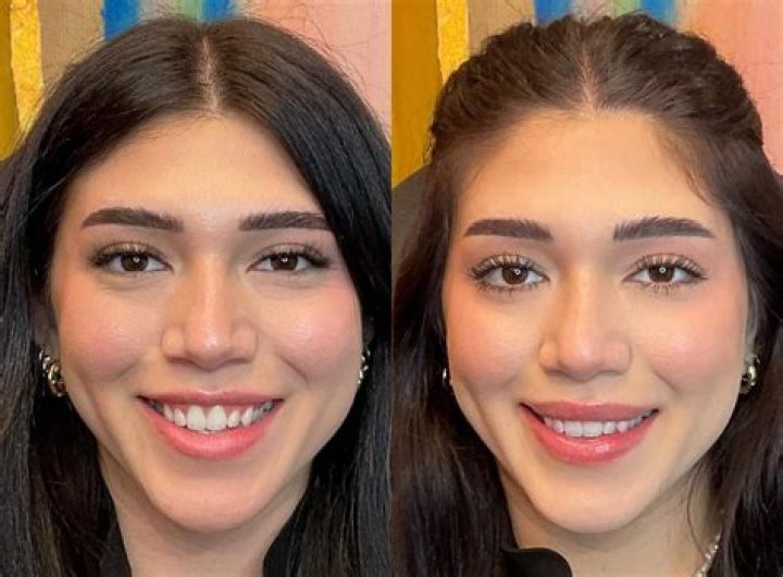 Kylie Jenner Is No Stranger to Plastic Surgery: Her Transformation Before and After Lip Fillers