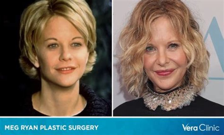 Plastic Surgery? Meg Ryan’s Face Causes a Stir at the Tony Awards