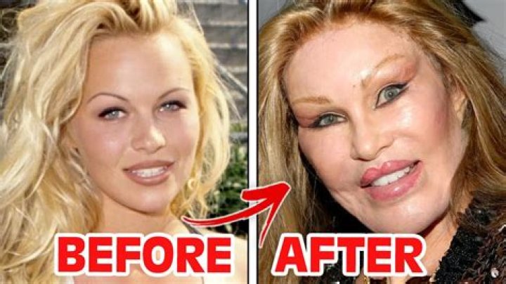 Plastic SurgeryThen-and-Now Photos of Celebrities Who Have Been Candid About Their Facelifts and More